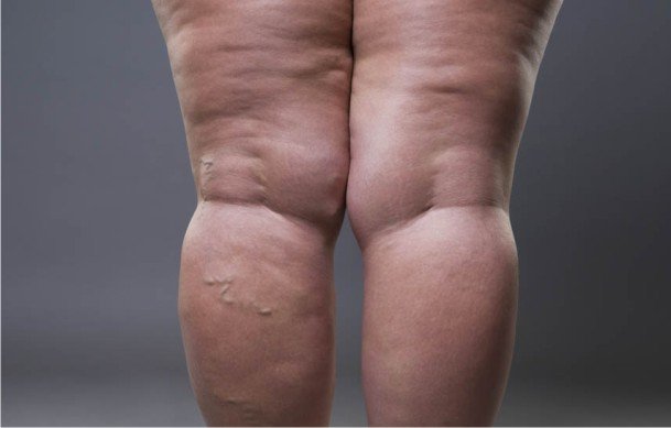 Lipedema: o que é, como identificar e quais os caminhos para o tratamento eficaz